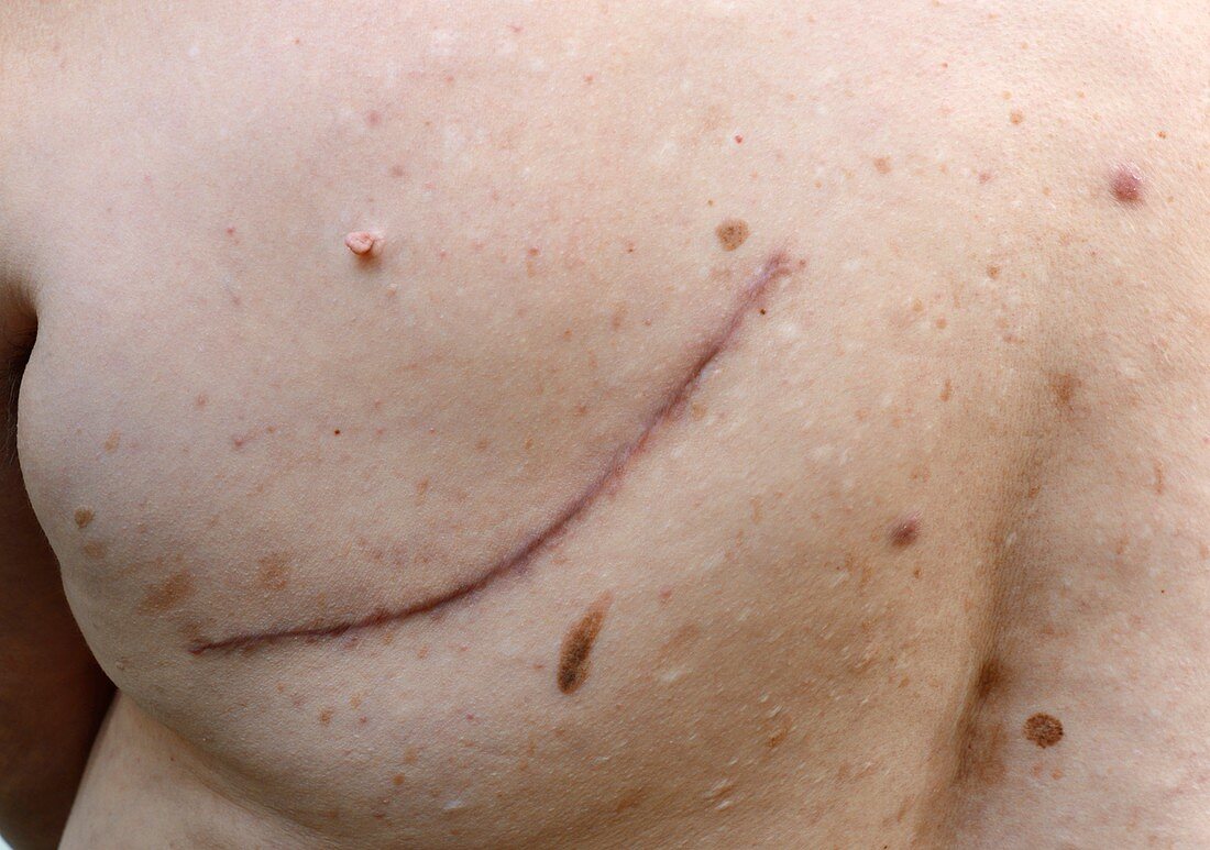 Scar from lung cancer removal