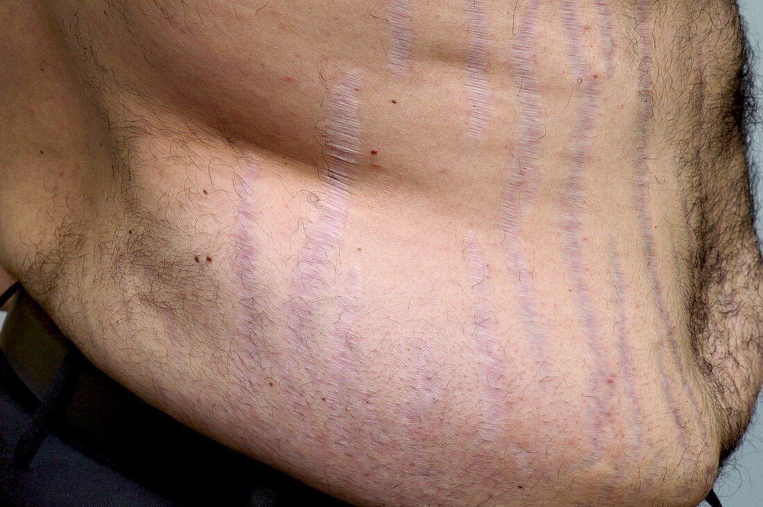 Stretch marks in Cushing's syndrome
