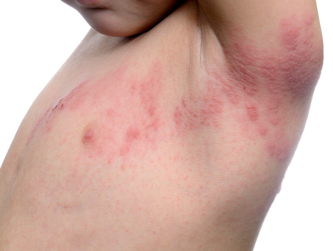 Shingles rash in a child