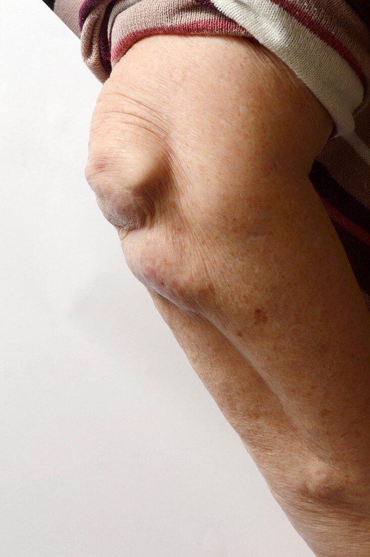 Rheumatoid arthritis in the elbow