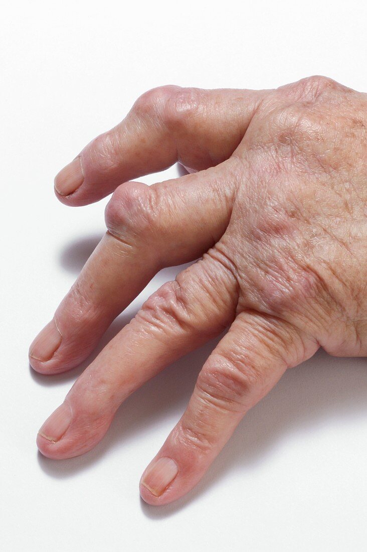 Rheumatoid arthritis of the fingers