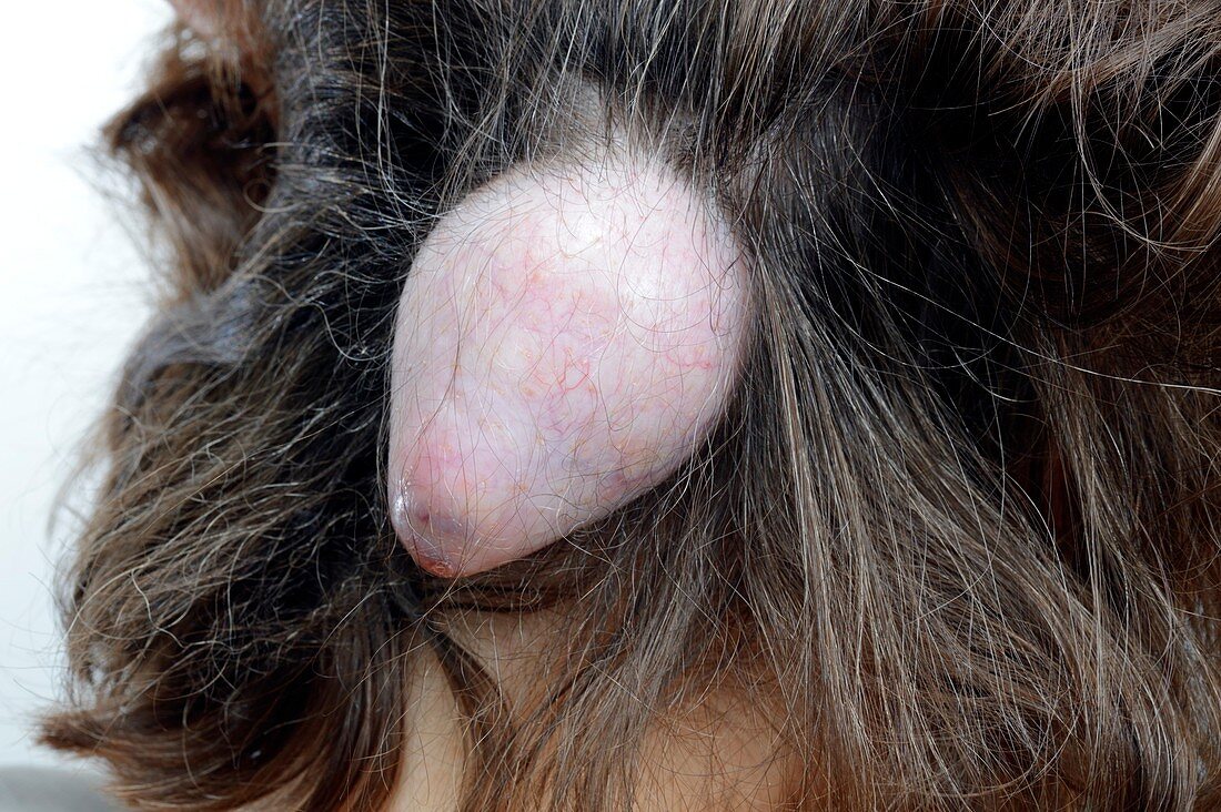 Sebaceous cyst on the scalp