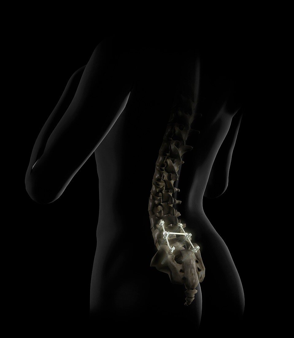 Lumbar spine fusion,artwork
