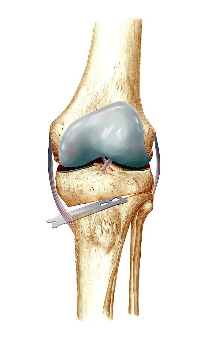 Knee osteotomy,artwork