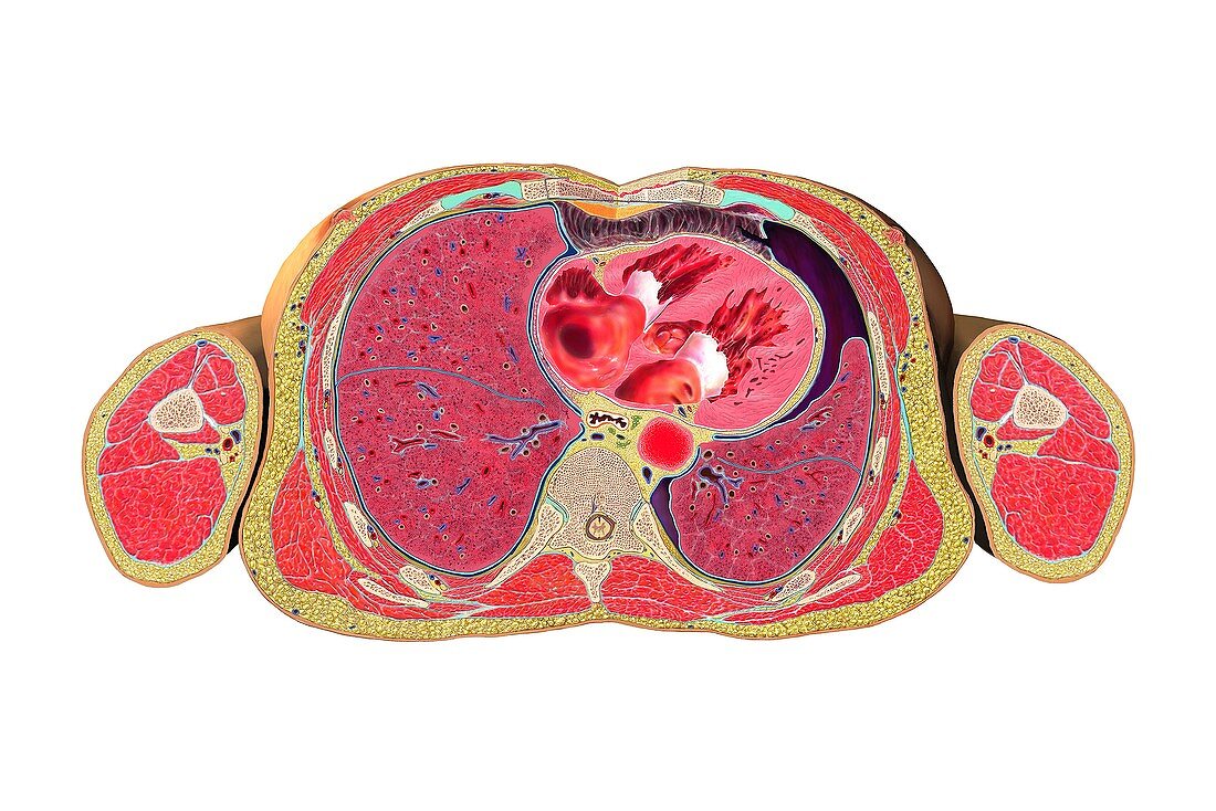 Pneumothorax cross-section,artwork