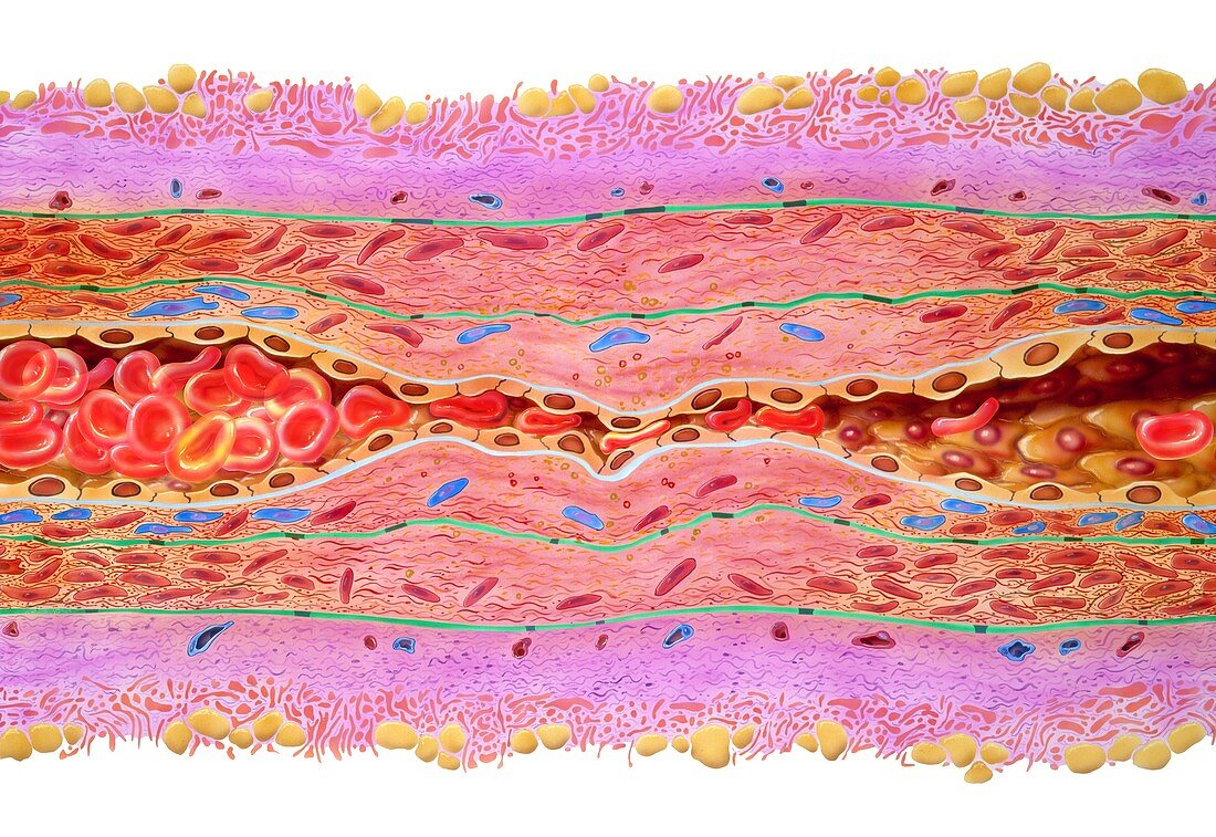 Atherosclerosis in artery,artwork