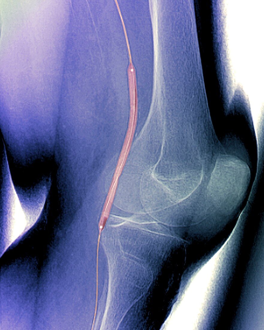 Balloon angioplasty,X-ray