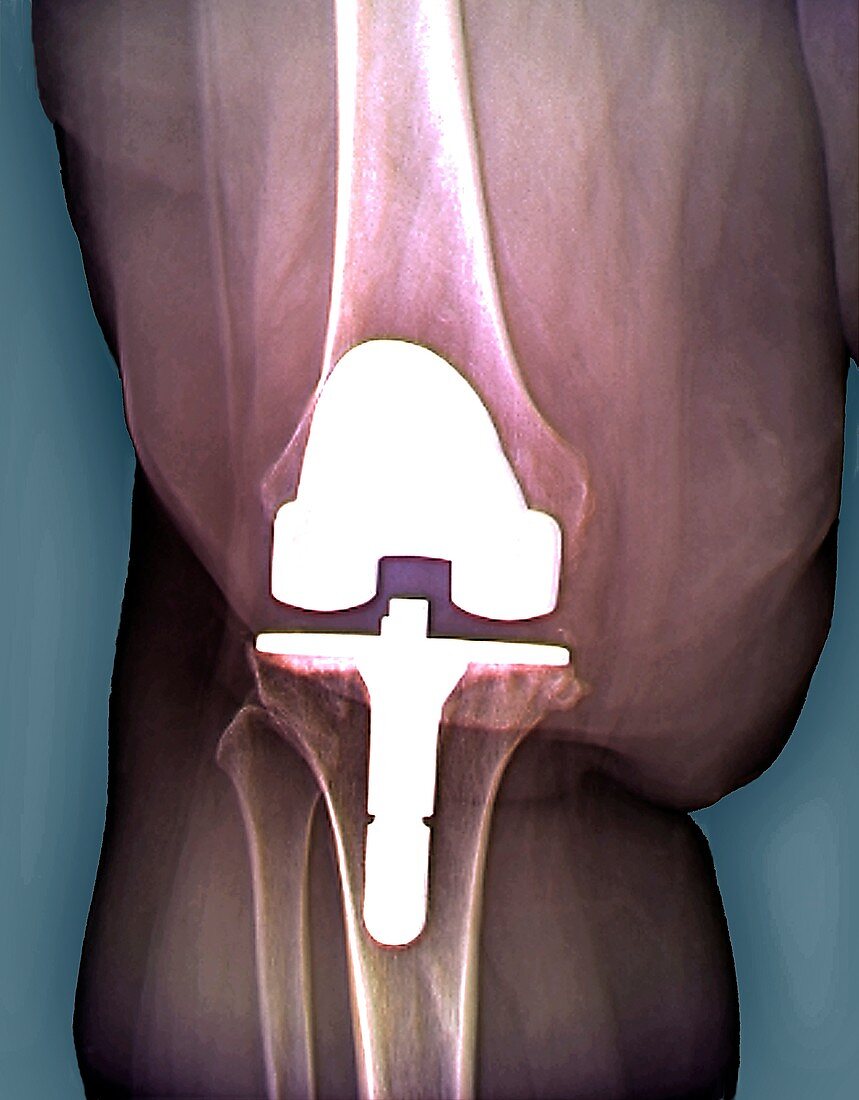Prosthetic knee and obesity,X-ray