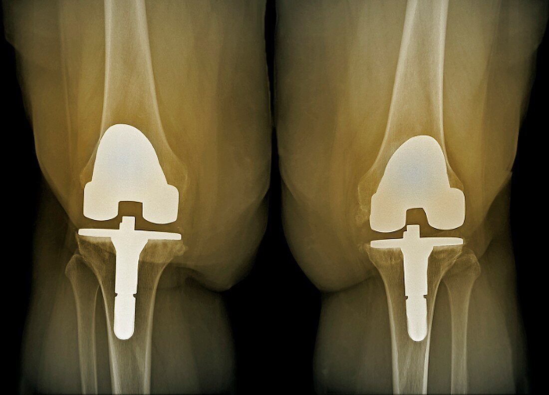Prosthetic knees and obesity,X-ray