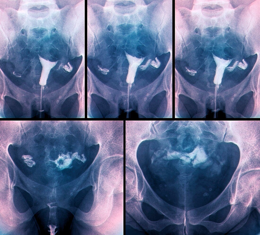 Blocked fallopian tubes,X-rays