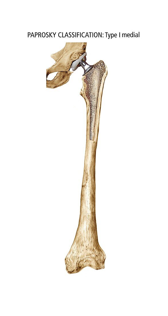 Paprosky femur defect,type I medial