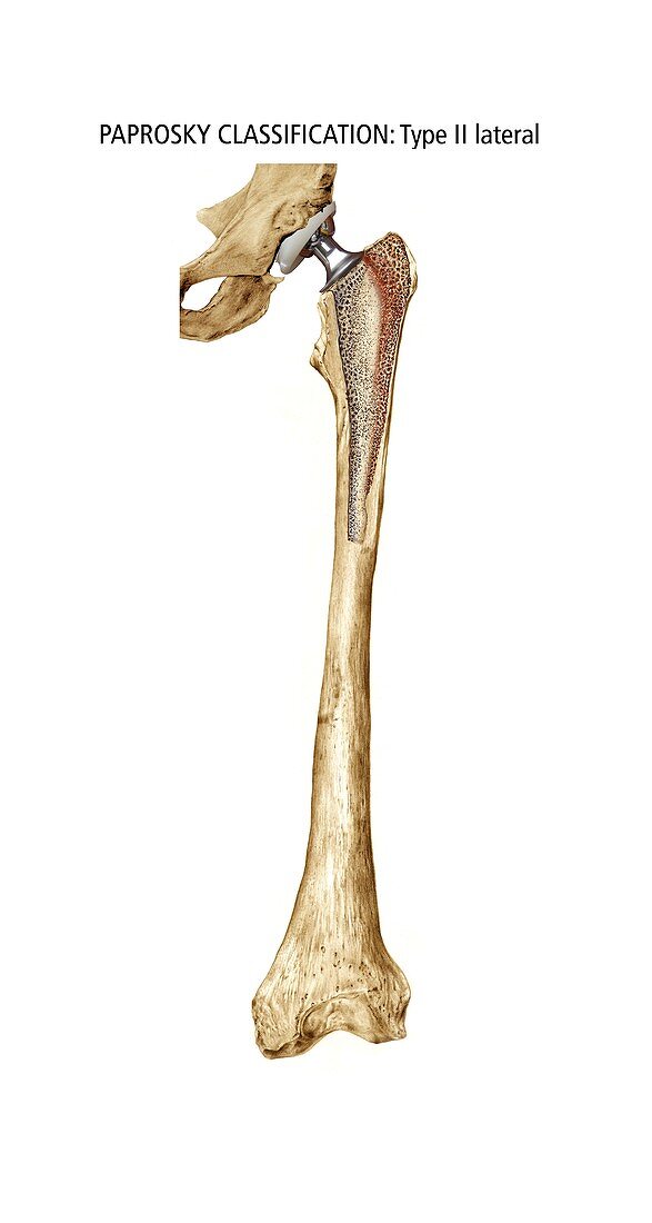 Paprosky femur defect,type II lateral