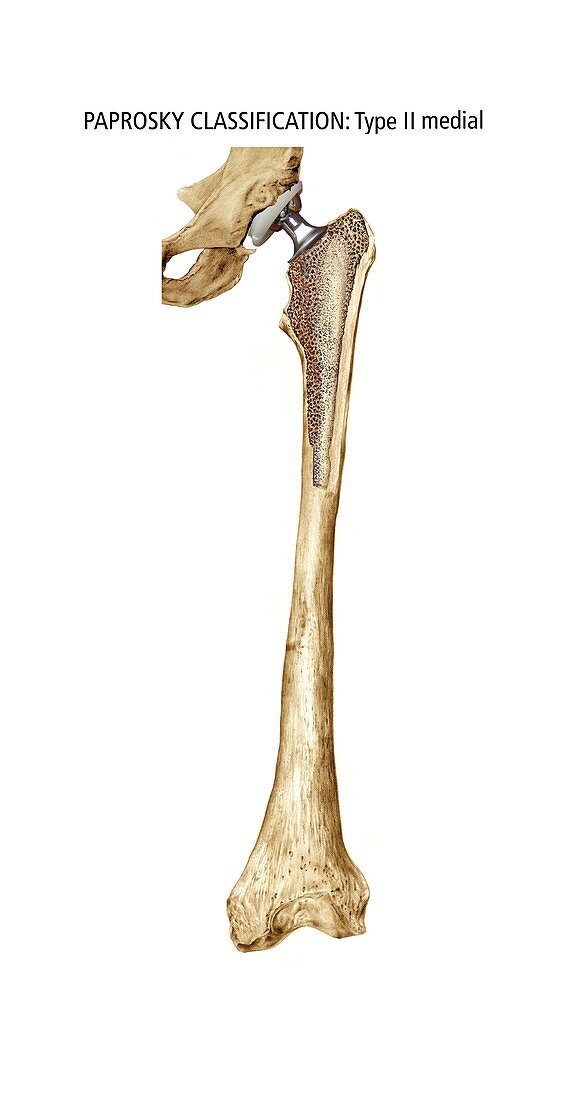 Paprosky femur defect,type II medial