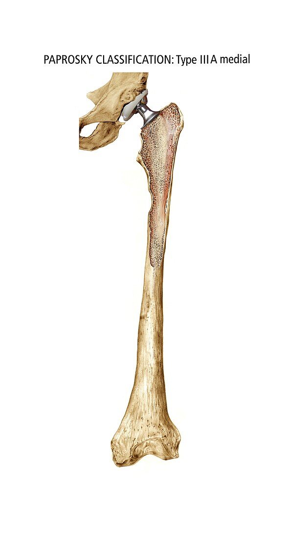 Paprosky femur defect,type IIIA medial