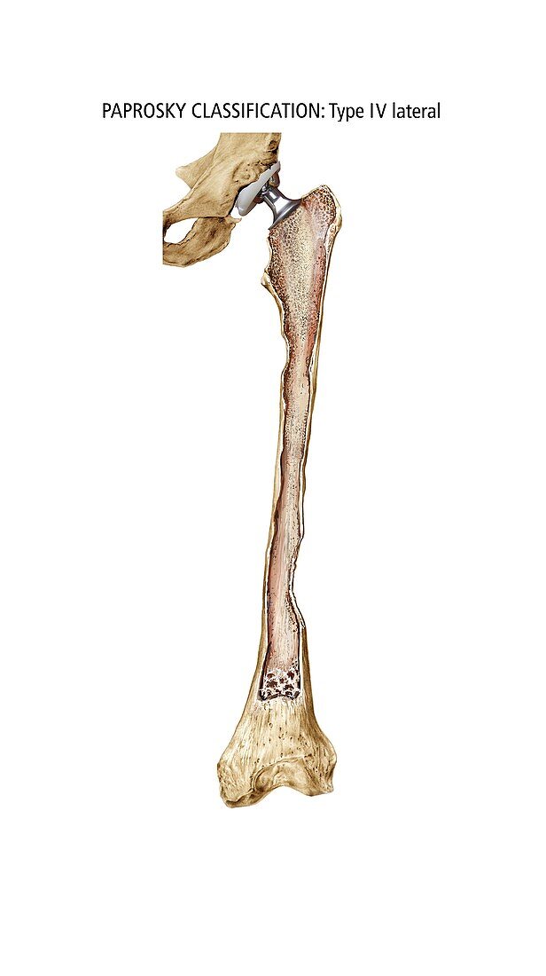 Paprosky femur defect,type IV lateral