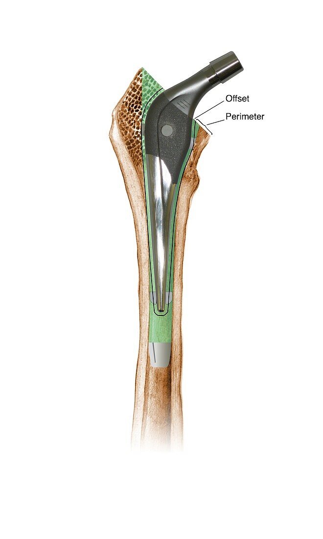 Prosthetic hip joint,diagram
