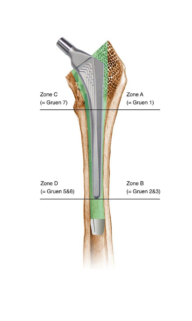 Prosthetic hip joint and Gruen zones