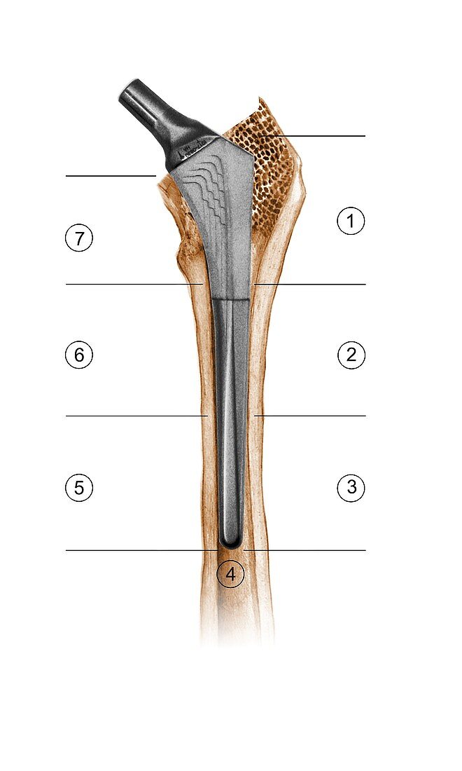 Prosthetic hip joint and Gruen zones