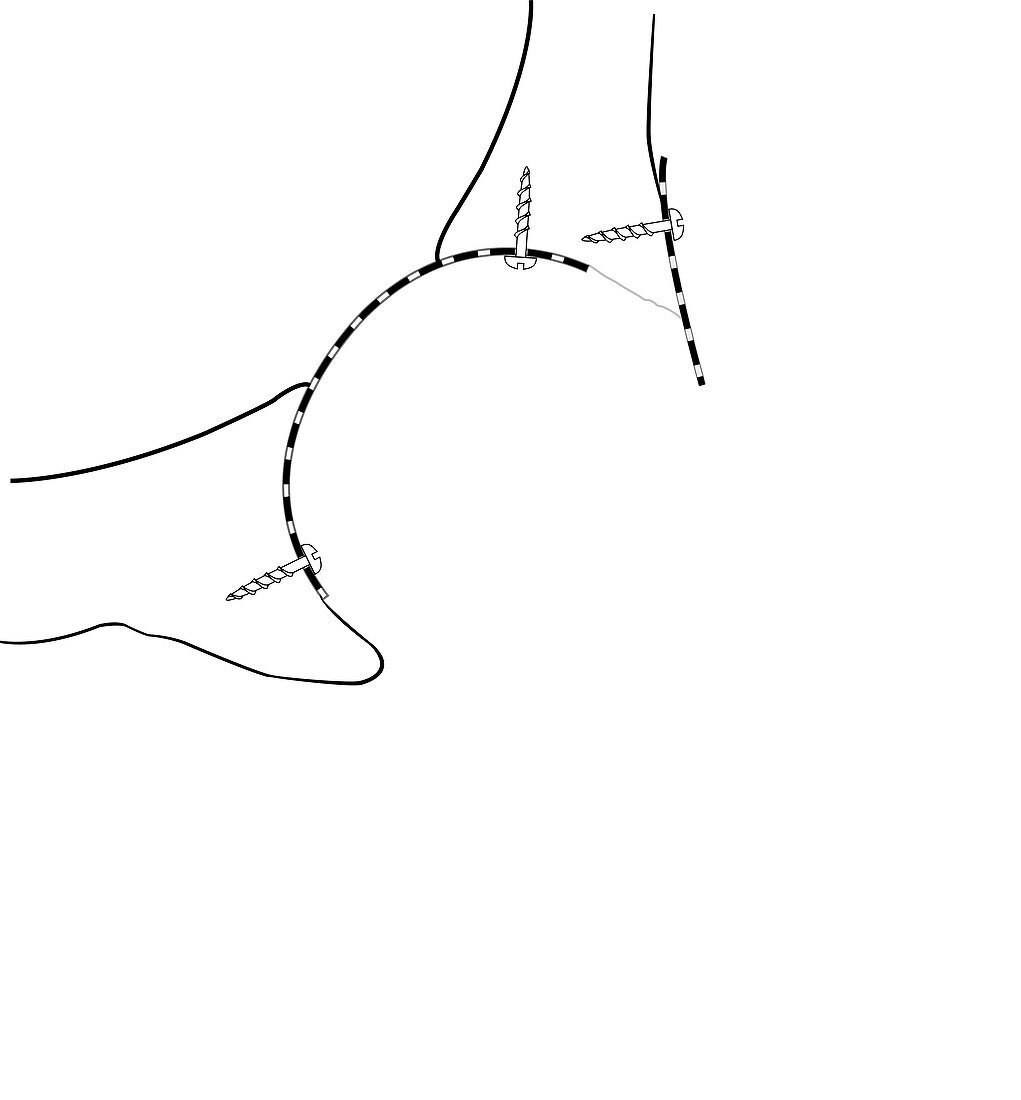 Hip socket bone grafting,diagram