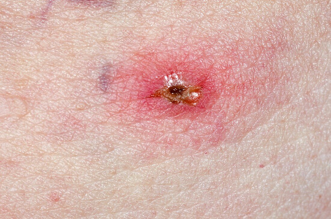 Infected tick bite