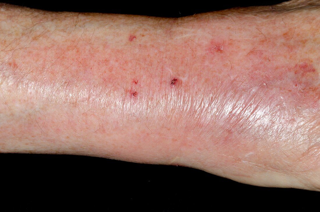 Infected cat bite on the wrist