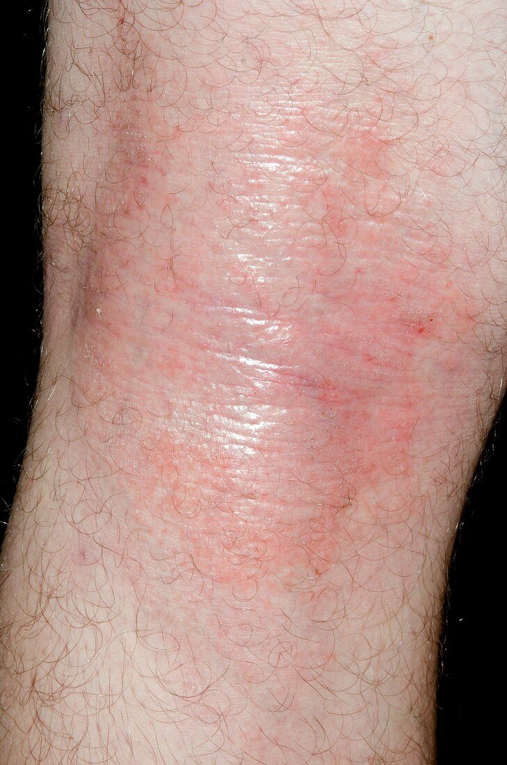 Atopic eczema behind the knee