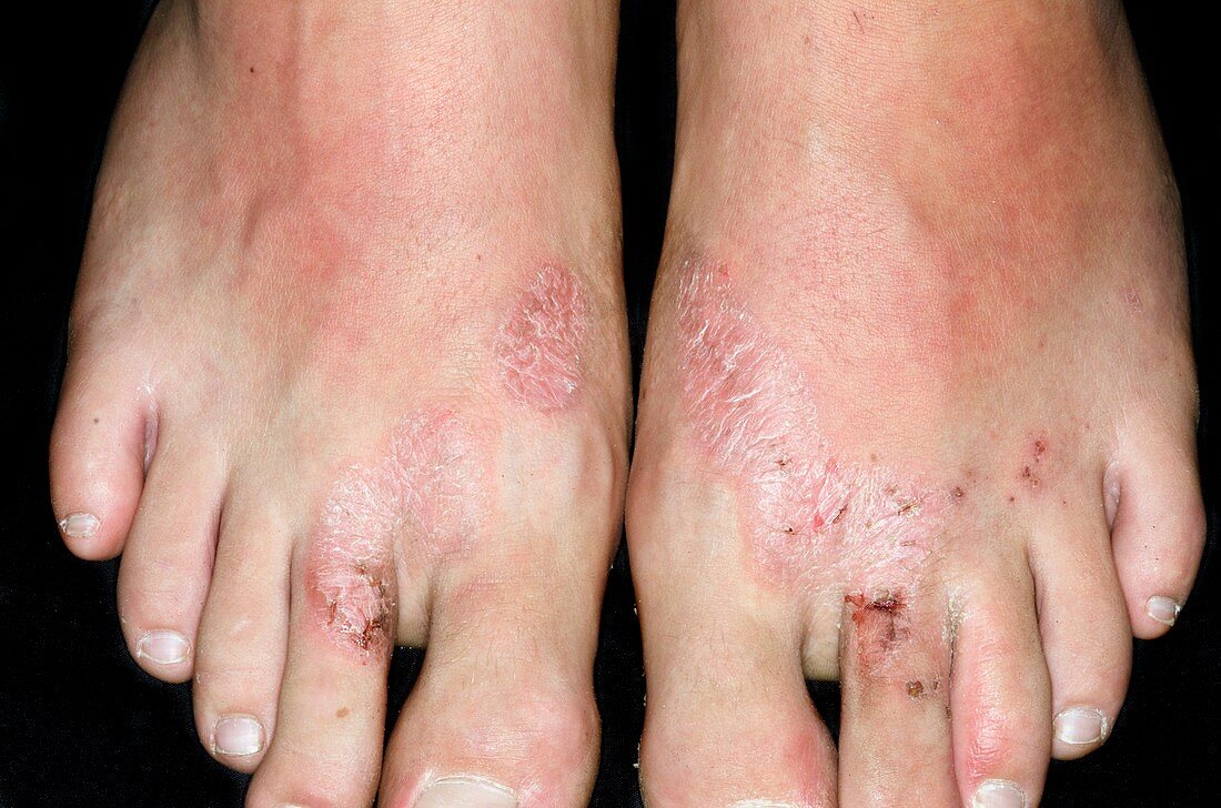 Allergic dermatitis from flip-flops