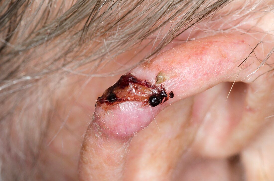 Basal cell skin cancer on the ear