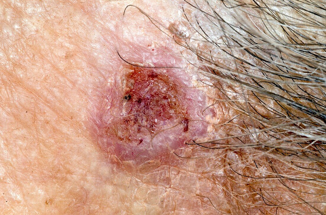 Basal cell skin cancer on the temple