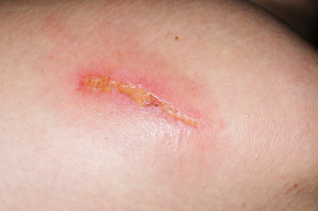 Infected laceration on the thigh