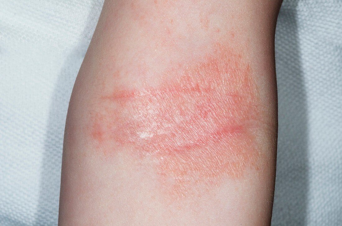 Atopic eczema behind the elbow