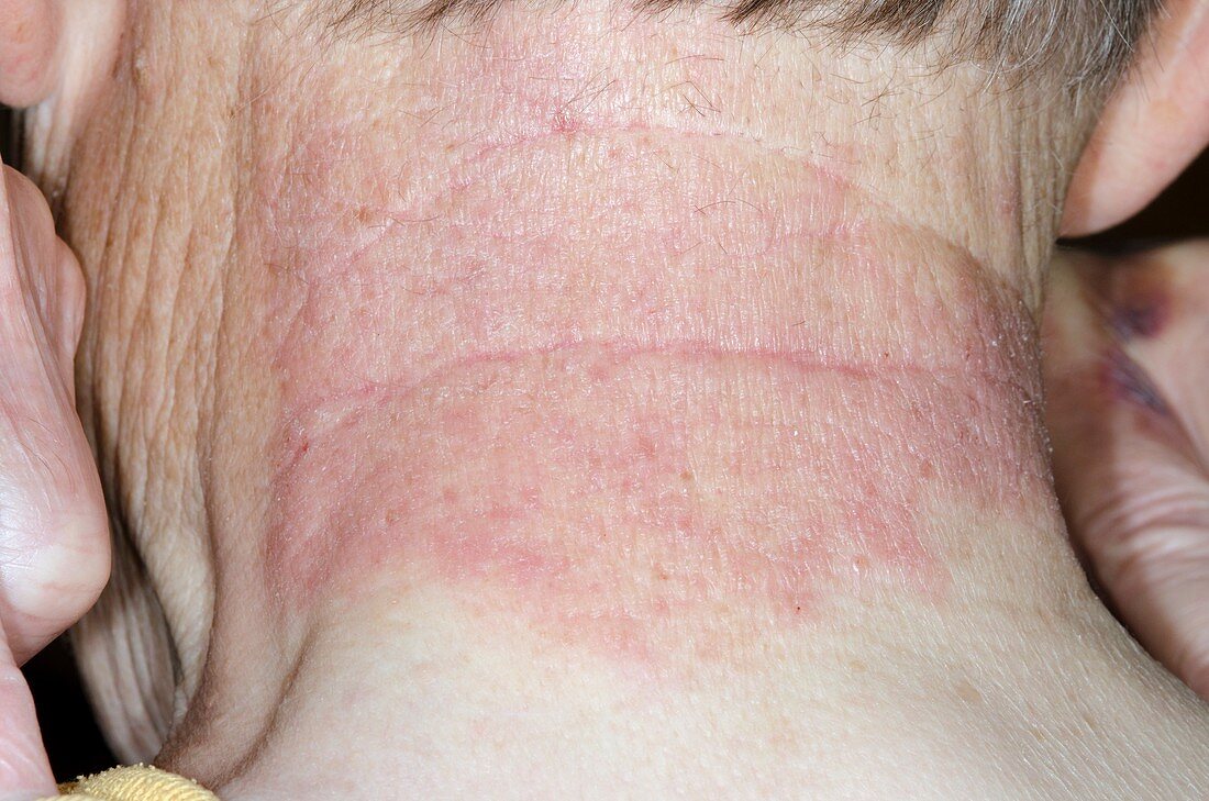 Contact dermatitis on the neck