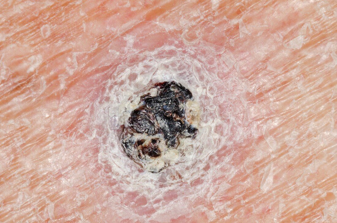 Skin lesion from stasis dermatitis