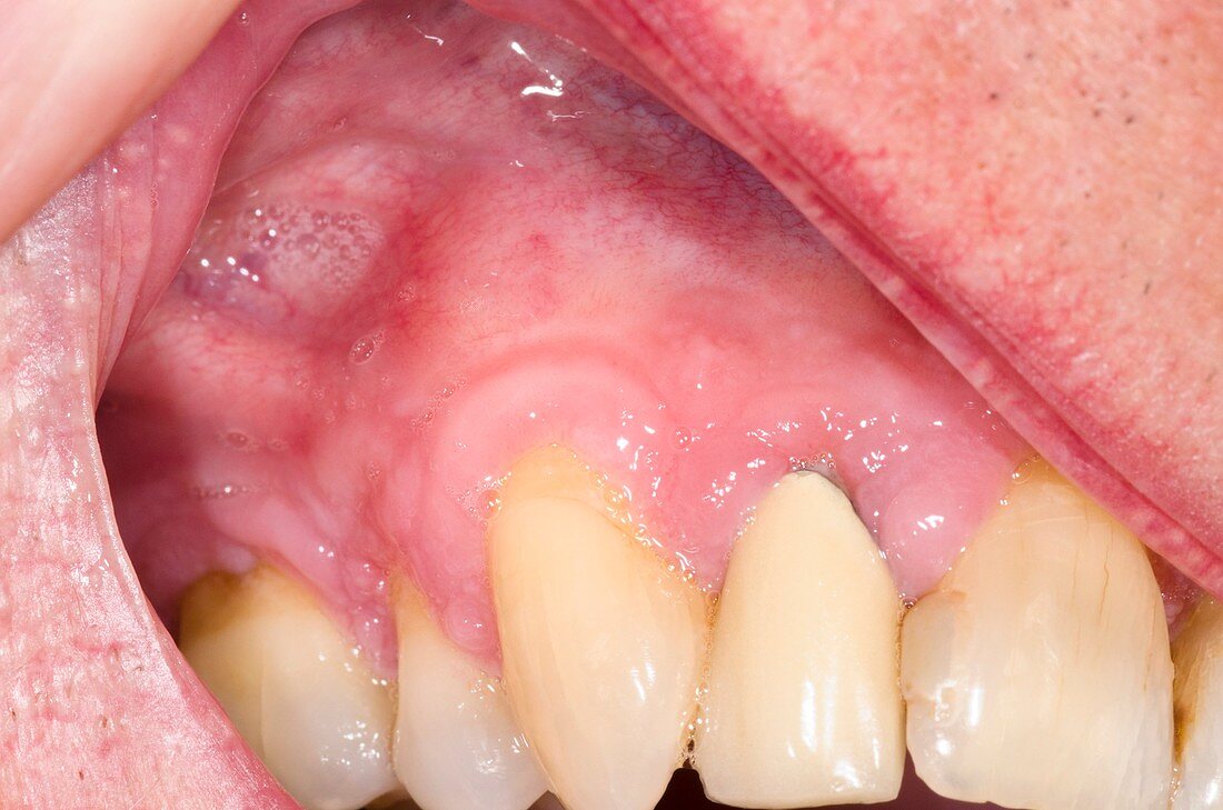 Gum hyperplasia from amlodipine drug