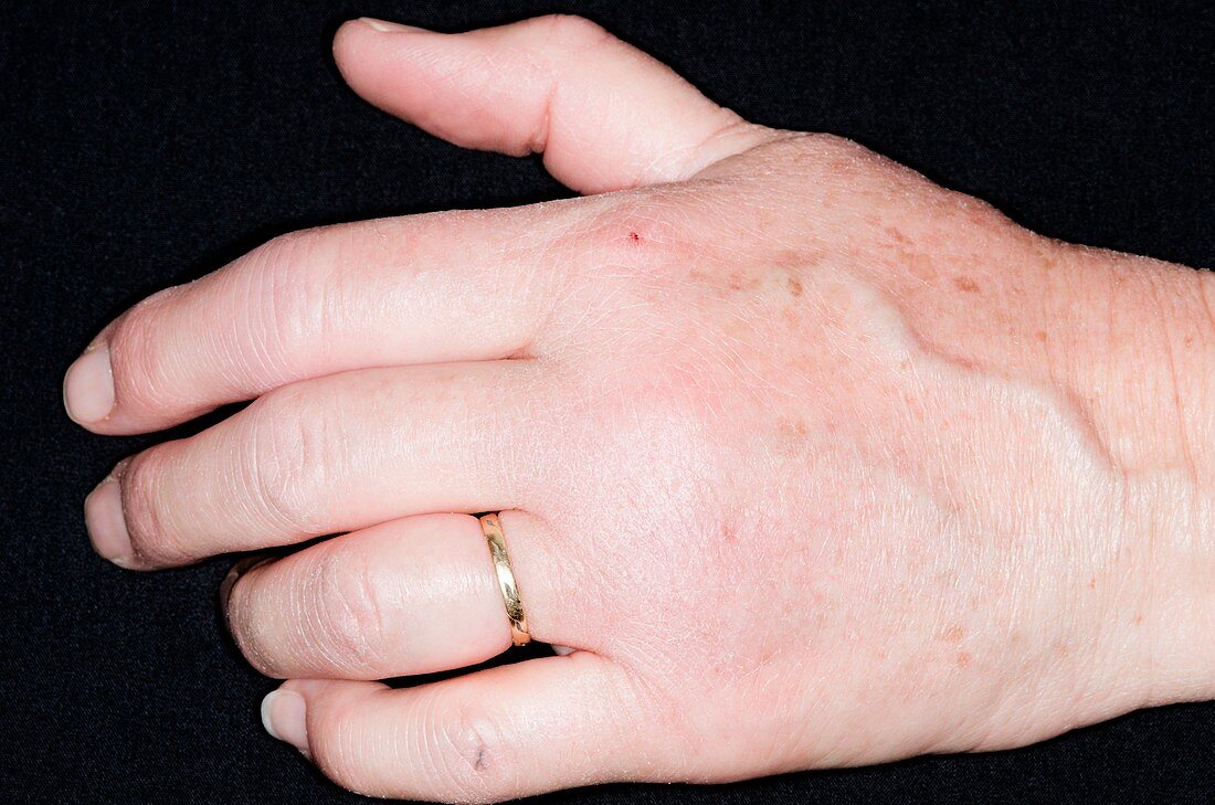 Swollen hand in rheumatoid arthritis