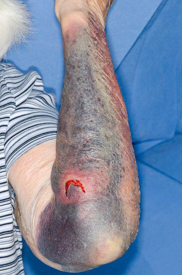 Flap laceration with bruising on arm