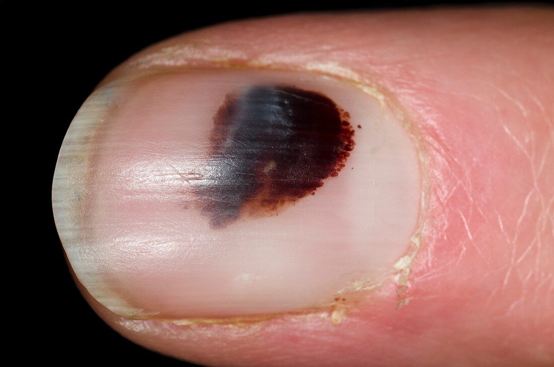 Bruise (haematoma) under fingernail