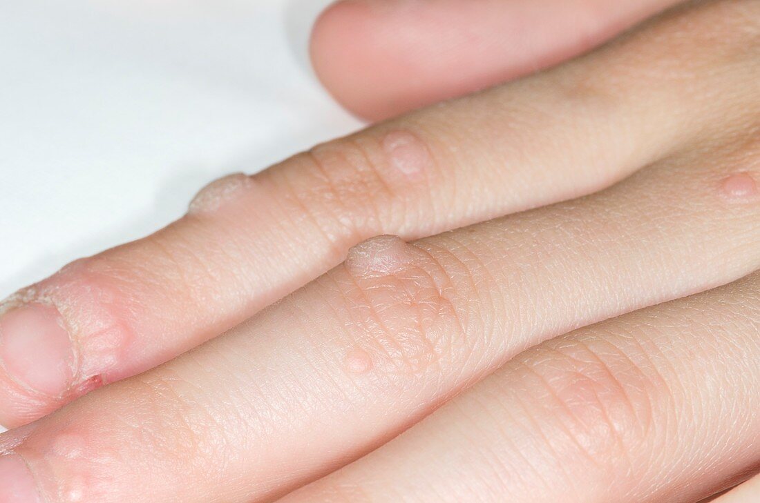 Warts on the fingers