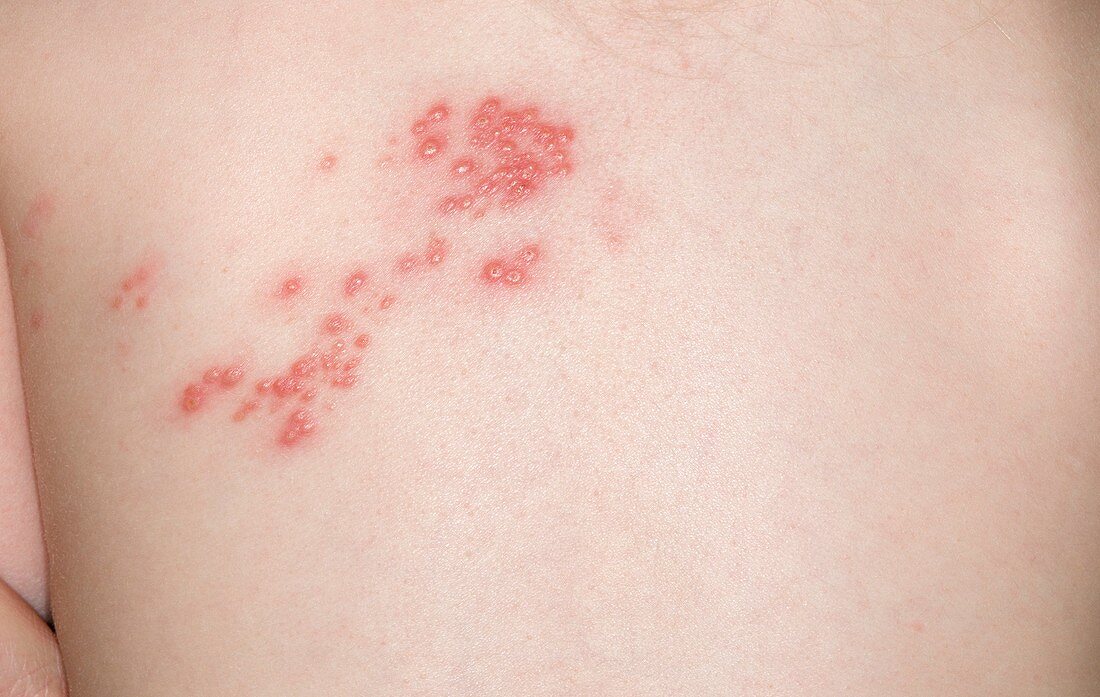 Shingles rash on the skin