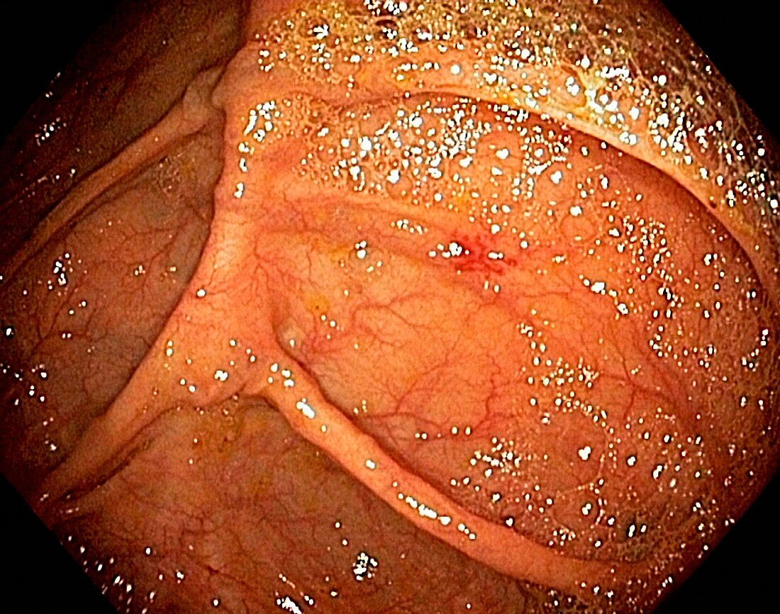 Angiodysplasia,endoscopic view