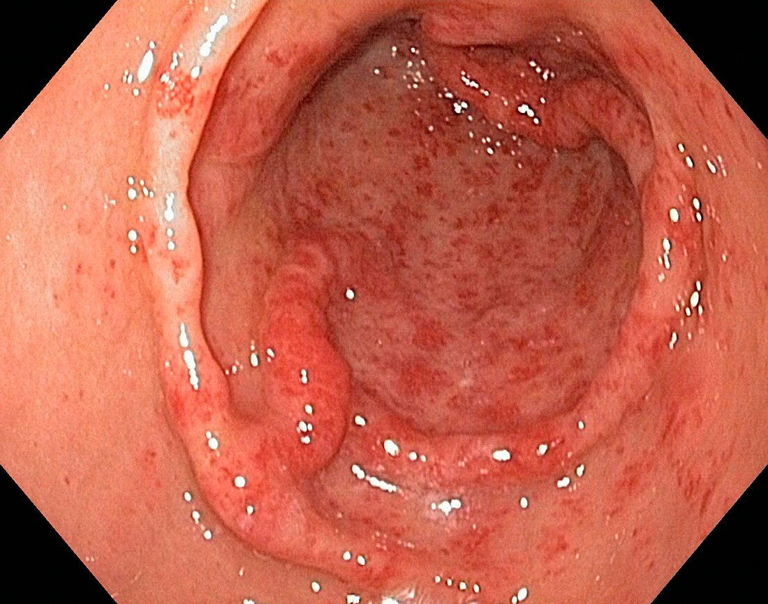 Gastric antral vascular ectasia