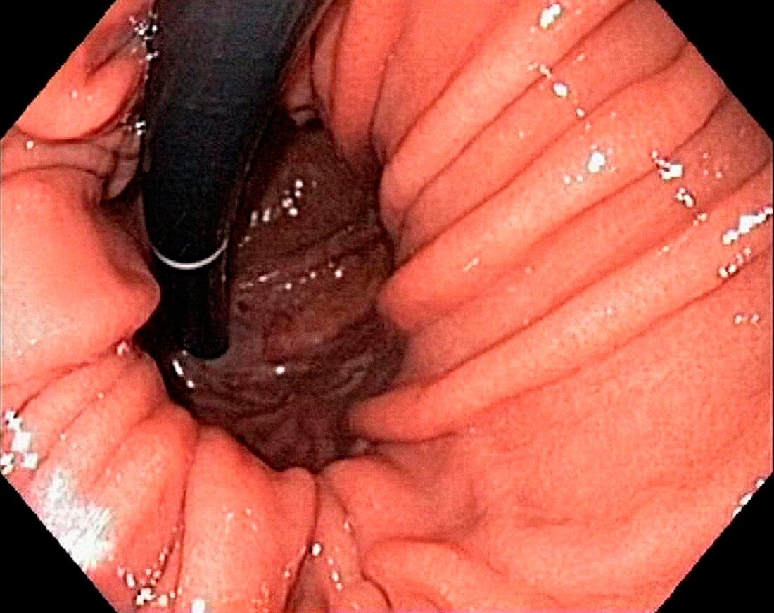 Hiatal hernia,endoscopic view