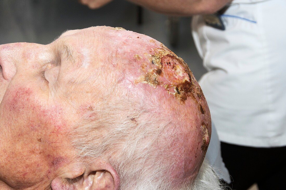 Squamous skin cancer on the scalp