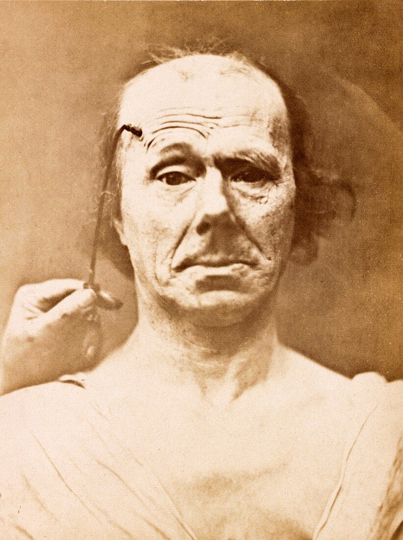 Duchenne's physiognomy studies,1860s