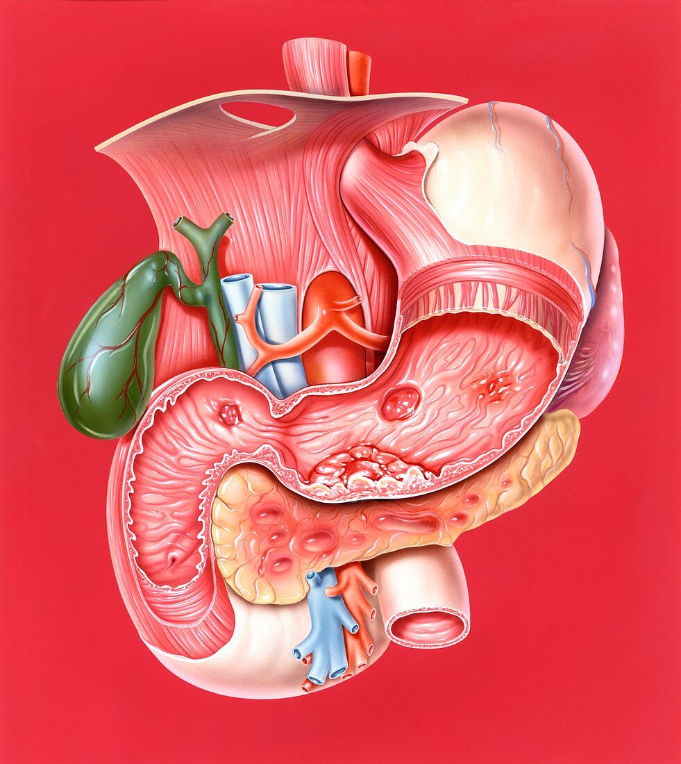 Gastrointestinal disorders,artwork