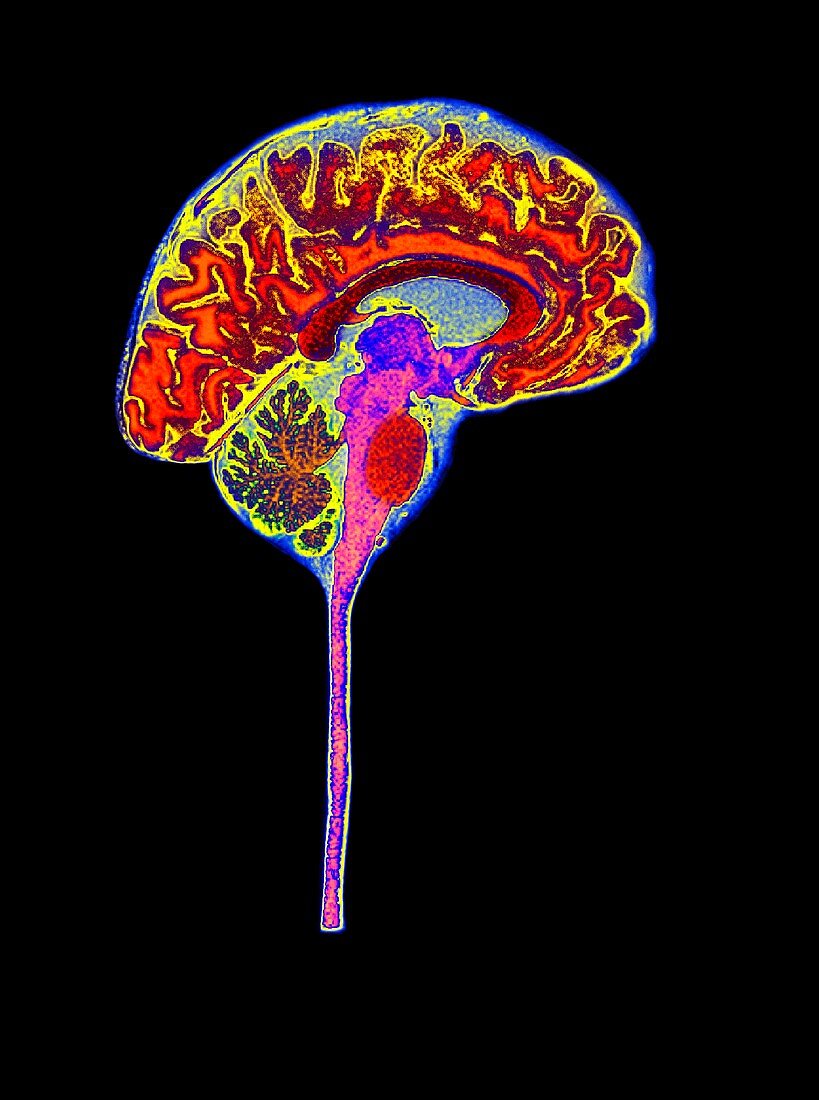 Normal human brain,MRI scan