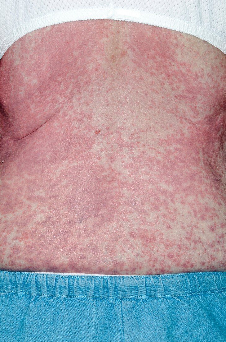 Skin rash after general anaesthetic