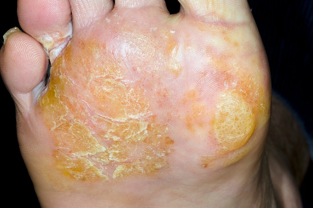 Pompholyx on sole of the foot