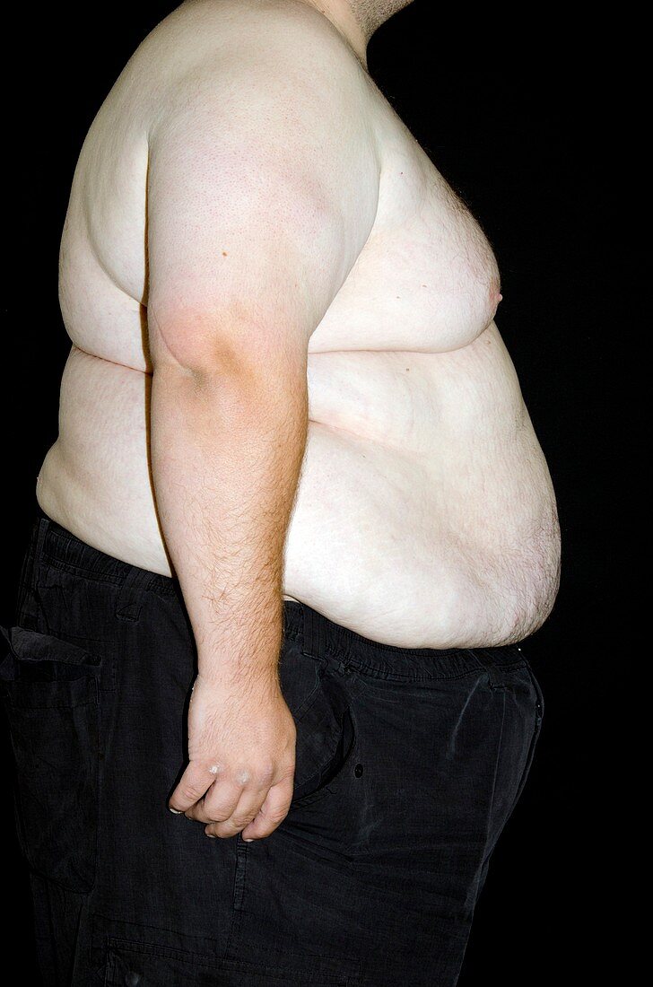 Male obesity