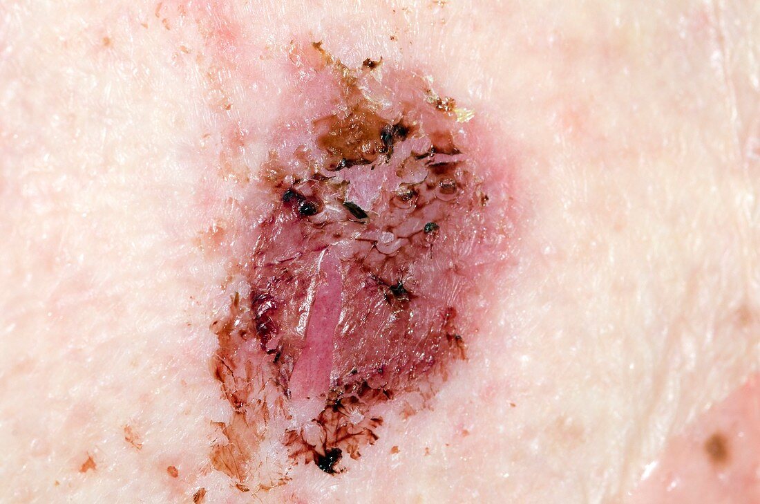 Healed pemphigoid blister